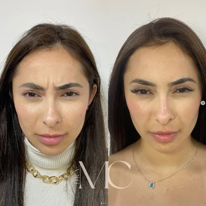Antes e depois de procedimento facial realizado na Plenah Clinic