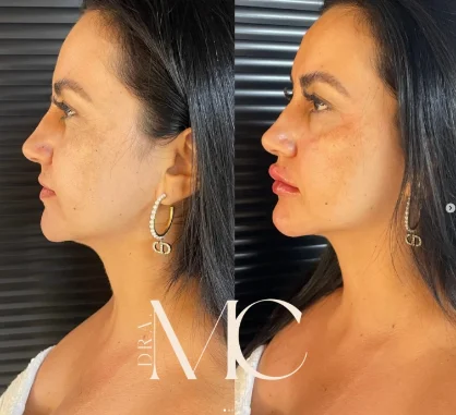 Antes e depois de procedimento facial realizado na Plenah Clinic
