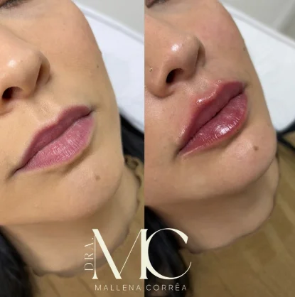 Antes e depois de procedimento facial realizado na Plenah Clinic