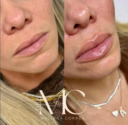 Antes e depois de procedimento facial realizado na Plenah Clinic