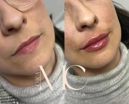 Antes e depois de procedimento facial realizado na Plenah Clinic